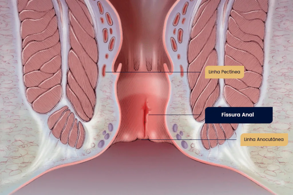 Fissura Anal: Sintomas, Causas e Como Tratar com Segurança