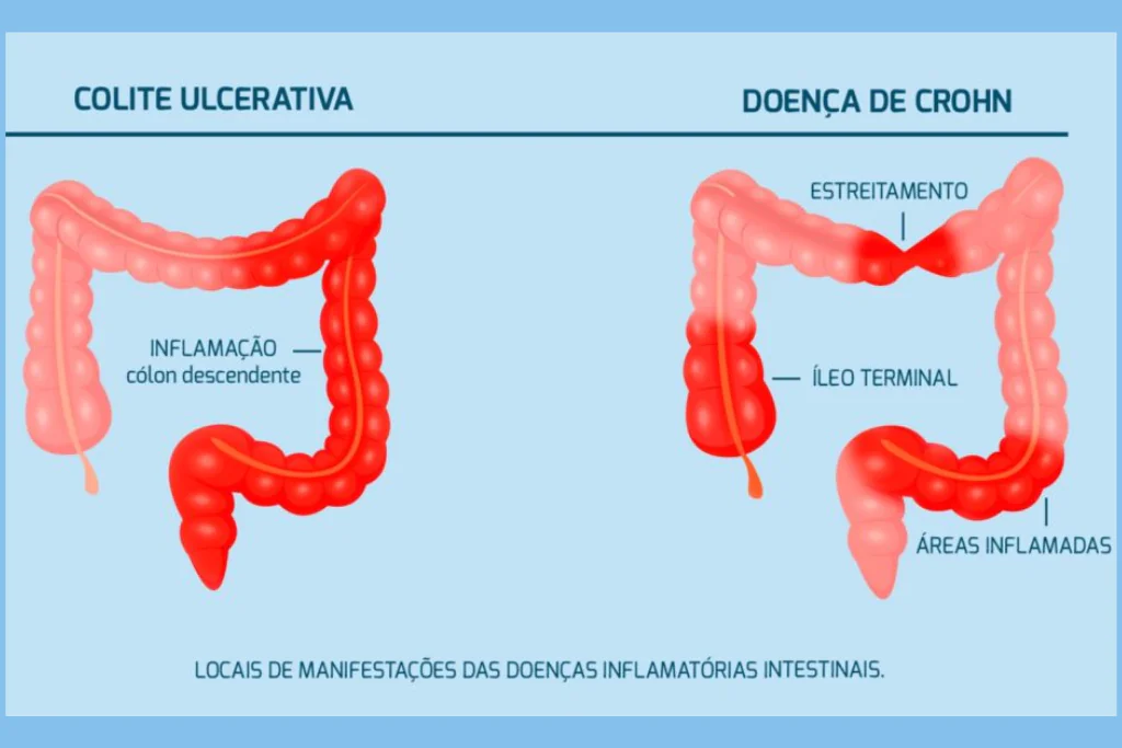 Compreendendo Doenças Inflamatórias Intestinais: Crohn e Retocolite Ulcerativa