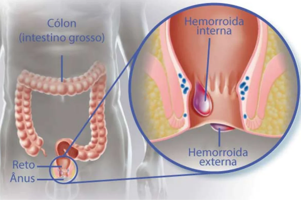 Hemorroidas Externas vs. Internas: Diferenças, Sintomas e Tratamento Adequado