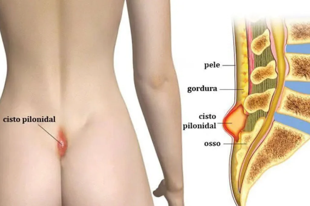 Cisto Pilonidal: Causas, Sintomas e Tratamento 