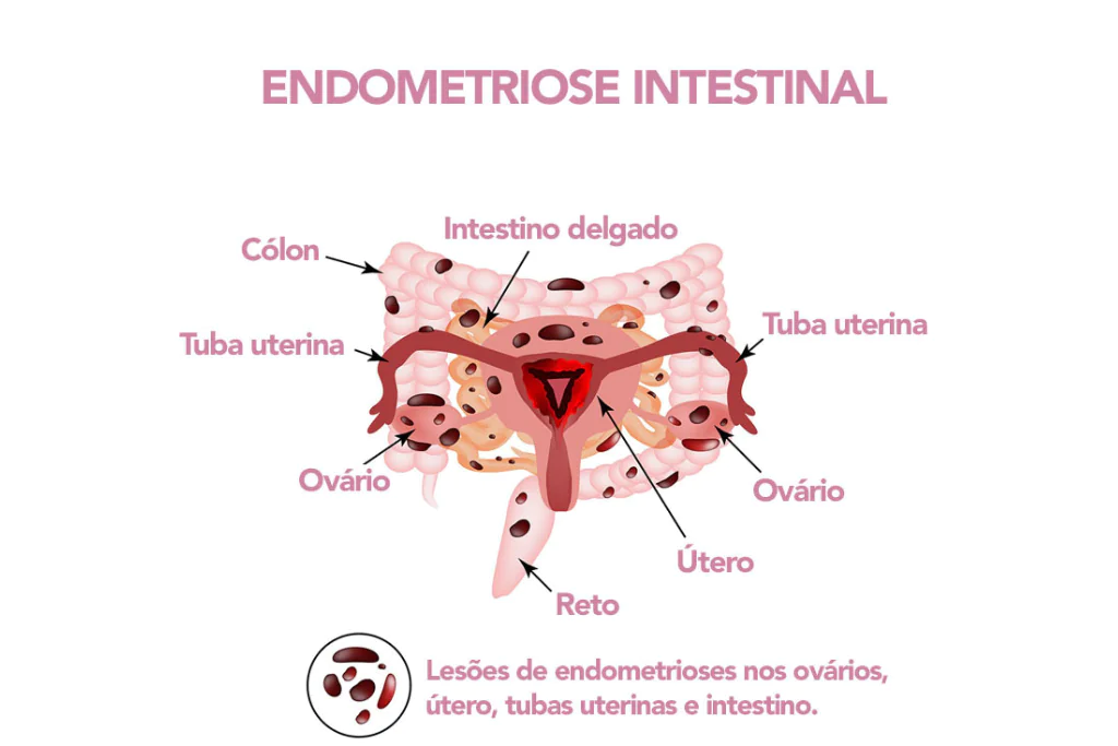 Endometriose Intestinal: Sintomas, Diagnóstico e Opções de Tratamento