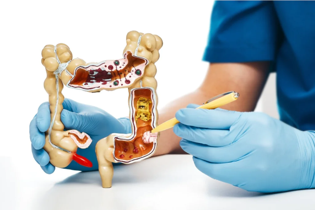 Prevenção do Câncer de Ânus: Fatores de Risco e a Importância do Diagnóstico Precoce